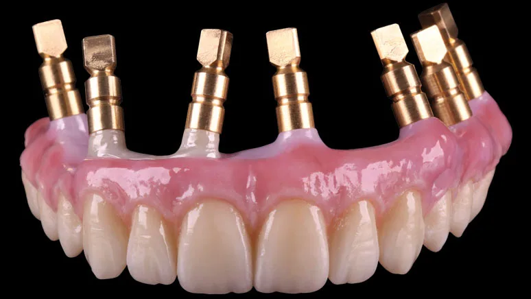 Implantatgetragene Brücke mit Abutments
